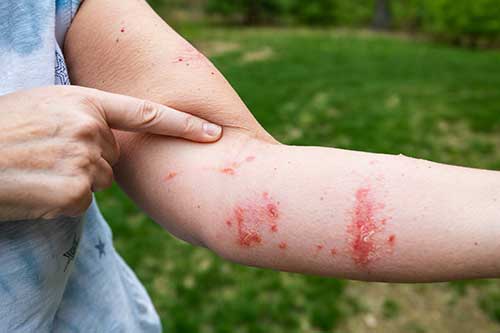 Another Name For Poison Ivy Dermatitis