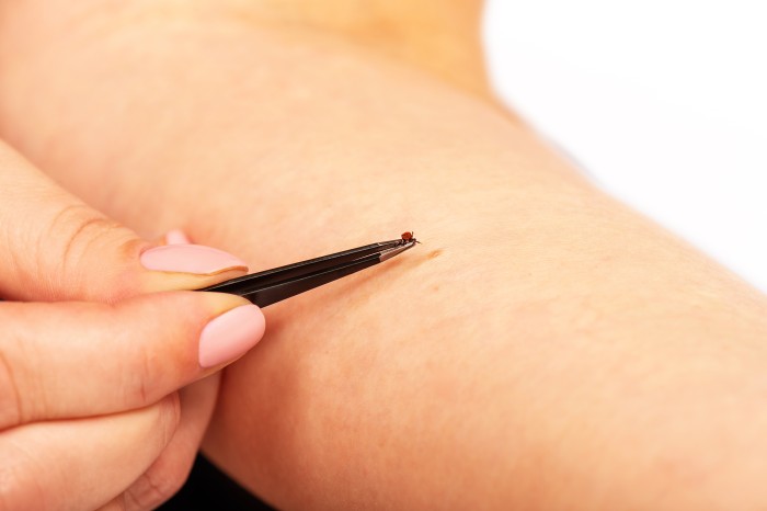 removing a tick with tweezers