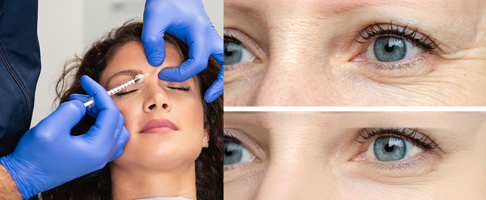 safest botox treatment in CT