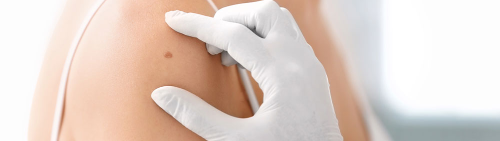 Dermatologist screening shoulder for melanoma during a skin cancer exam