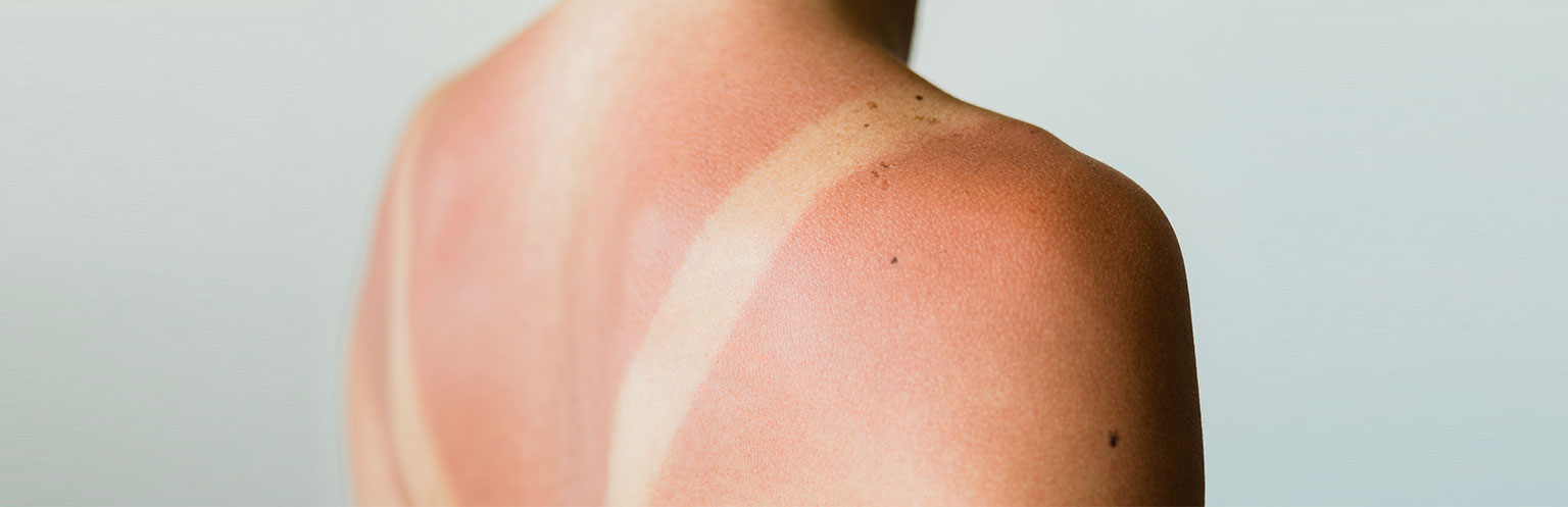 sunburned back on woman