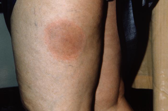 thigh of a patient who had presented with what was diagnosed as Lyme disease